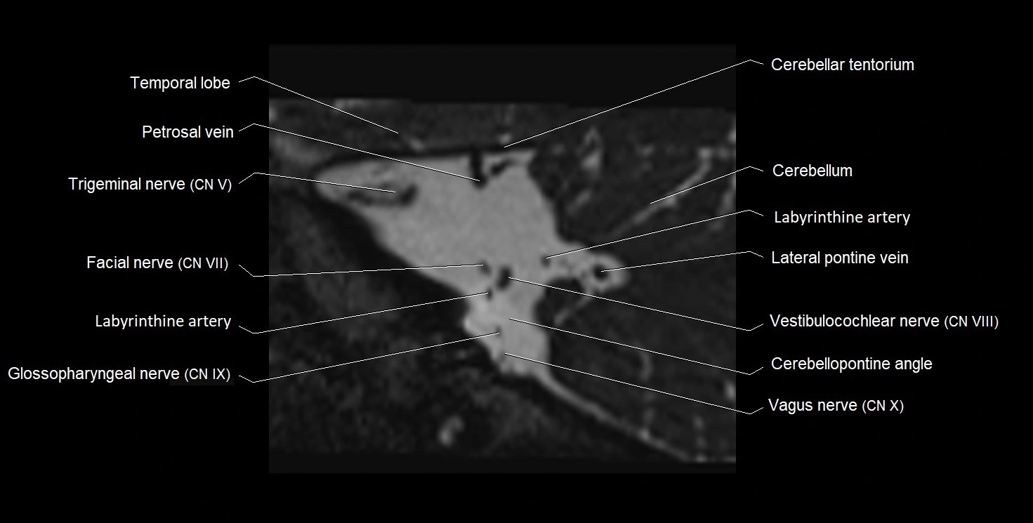 Internal auditory meatus (IAM) 3T sagittal cross sectional anatomy image 32.webp